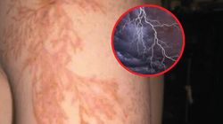 Oczy robią się czarne, a na ciele pojawia się "rozgałęzione drzewo". Przeżywa 50 proc. osób