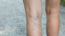 Podwyższone D-dimery po COVID-19. Badanie ujawni zmiany zakrzepowe