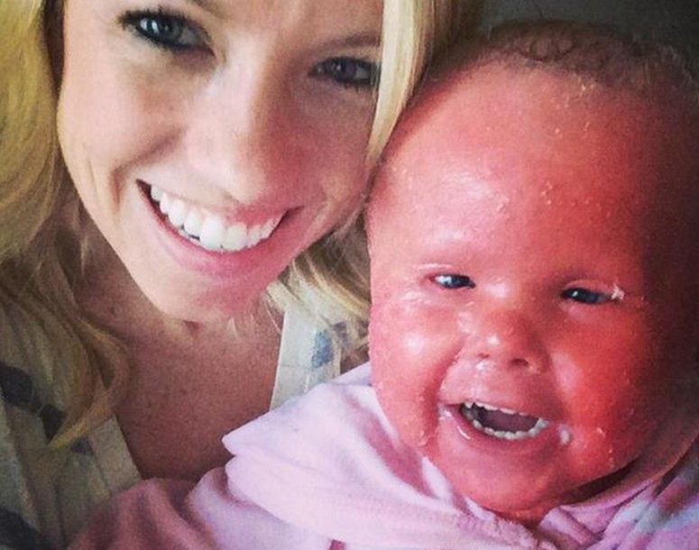 Rybia łuska arlekinowa - Płód arlekin - ta dziewczynka urodziła się z