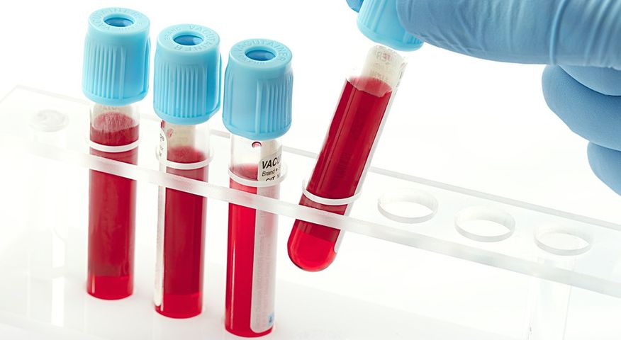 Podwyższone OB w badaniu krwi może świadczyć o stanie zapalnym w organizmie