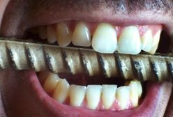 Stres zjada twoje zęby? Cierpisz na bruksizm