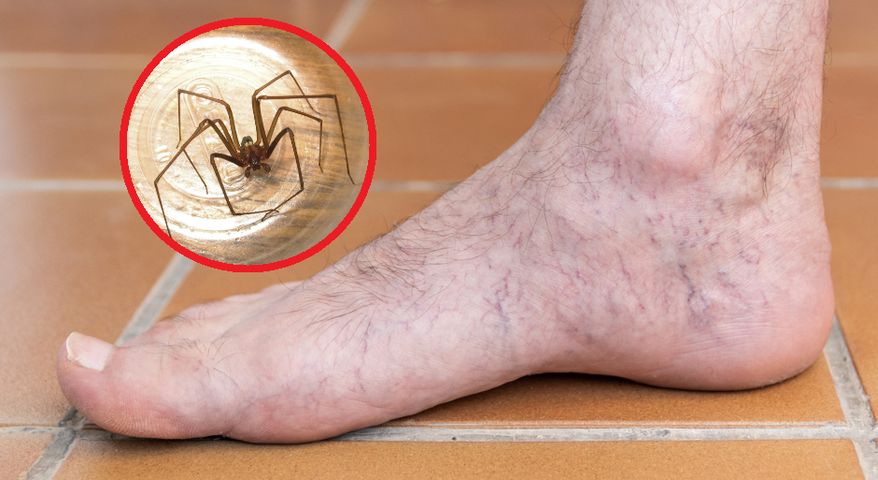 Nawracający problem mężczyzny może być spowodowany ukąszeniem pająka
