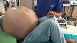 Największy guz jajnika na świecie. Ważył 50 kg