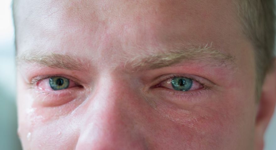 Podkrążone oczy – przyczyny, zagrożenia