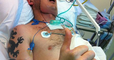 Pacjent po przeszczepie twarzy opuszcza szpital w Gliwicach