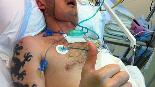 Pacjent po przeszczepie twarzy w Centrum Onkologii w Gliwicach