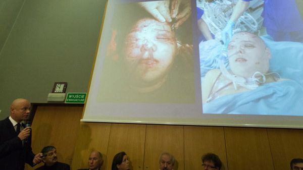 Drugi całkowity przeszczep twarzy w Polsce