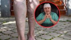 Lekarz zdradza pięć objawów objawów zakrzepicy. Pojawiają się u 50 proc. pacjentów