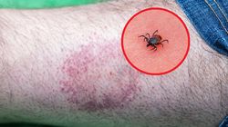 Niebezpieczny wirus przenoszony przez kleszcze. Potwierdzono pierwszy przypadek w Wielkiej Brytanii