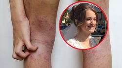 Zaczęło się niewinnie. To był pierwszy znak, że jej nerki zaczynają wysiadać