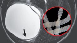 Wyjęli to z mózgu nastolatka. Tak atakował tasiemiec