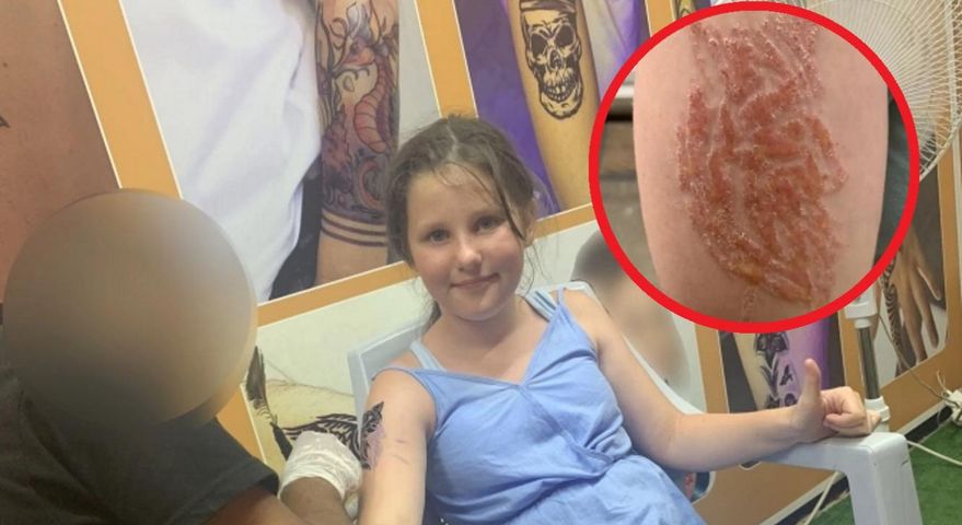 Tatuaż z henny wywołał u dziewczynki ostrą reakcję alergiczną