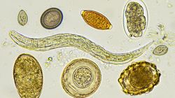 Włosogłówczyca (trichurioza) - przyczyny, objawy, rozpoznanie, leczenie