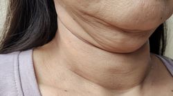 Pierwsze objawy przypominają przeziębienie. W Polsce nowotwory głowy i szyi są diagnozowane za późno