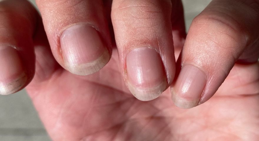 Zmiany na płytce paznokcia mogą być jednym z pierwszych objawów marskości wątroby