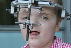 Dziewczynka z zespołem Aperta opuszcza szpital