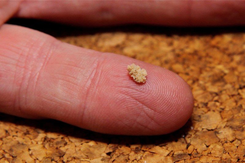 Kamica nerkowa (prezentacja edukacyjna)