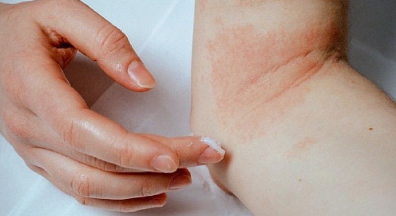 Jak wygląda atopowe zapalenie skóry?