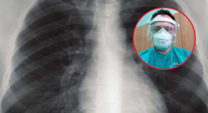 Zmiany w płucach pacjenta z koronawirusem