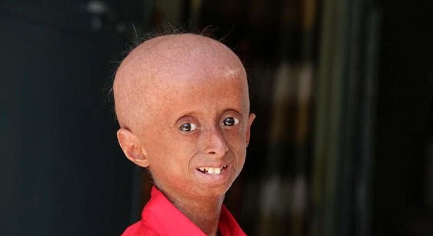 Choruje na progerię. Nastolatek wygląda jak emeryt
