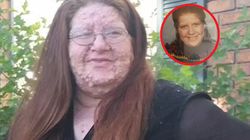 Zaczęło się od drobnej zmiany na skórze. Dziś twarz kobiety w całości pokryta jest guzami