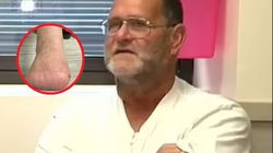 Wybrał się na ryby. Przez jedno ukąszenie amputowano mu palce