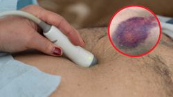 Zwiastuje ostre zapalenie trzustki. Pod żadnym pozorem nie ignoruj znaku Cullena