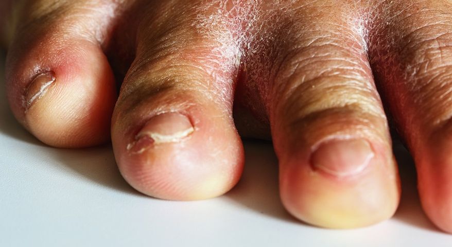 Zmiany widać na paznokciach. To może być objaw poważnej choroby