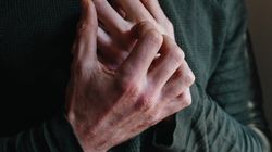 Jeden z pierwszych objawów raka trzustki. Gdy go zauważysz, nie czekaj ani chwili