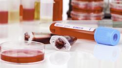 Pierwsze badania w diagnostyce białaczki