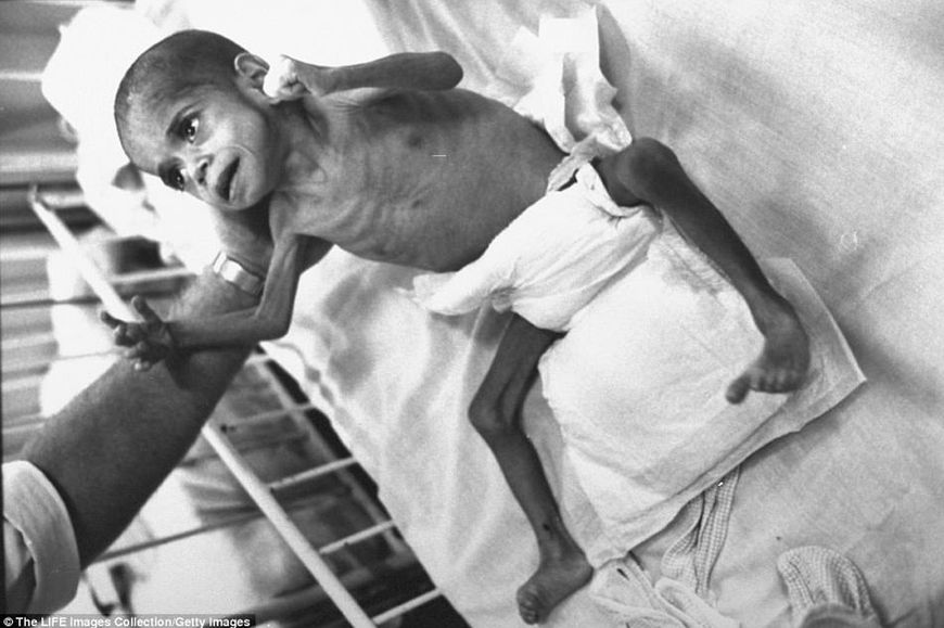 Dziecko chore na AIDS - Rumunia 1980 rok
