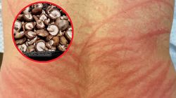 Źle ugotował grzyby. Na plecach pojawiła się smugowata wysypka