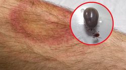 Sąd zadecydował. Metoda ILADS w leczeniu boreliozy jest groźna. Może trwale uszkodzić wątrobę i nerki