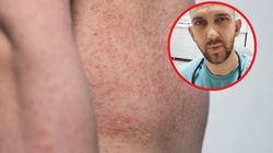 45-krotny wzrost zachorowań. Wirus wyniszcza wątrobę i mózg, może doprowadzić do utraty wzroku