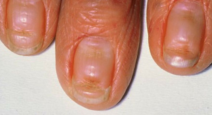 Cukrzyca widoczna na paznokciach? Sprawdź, na co zwrócić uwagę