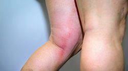 Zwiastują nowotwór i zakrzepicę. Najważniejszy objaw