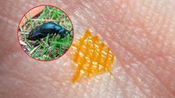 Toksyczny chrząszcz w Polsce. Tak rozpoznasz, czy miałeś z nim kontakt