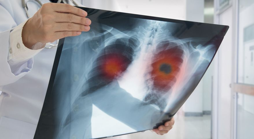 Z powodu nowotworu płuc każdego roku umiera ponad 23 tys.pacjentów w Polsce