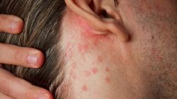 Zaczyna się od "zwykłej" wysypki. Znak, że zaatakował groźny nowotwór