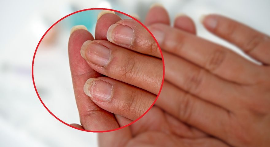 Niektóre objawy demencji mogą być widoczne na skórze i paznokciach oraz we włosach