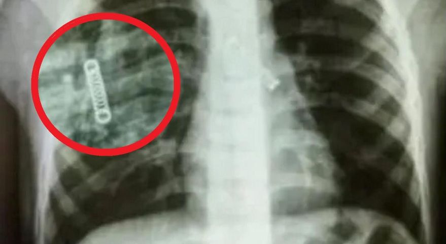 Odkryli to w płucach 5-latka. "Trzy miesiące kaszlu i nikt go nie zabrał do lekarza"
