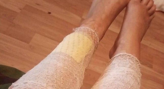 Zabieg IPL poparzył Anastasii skórę na nogach