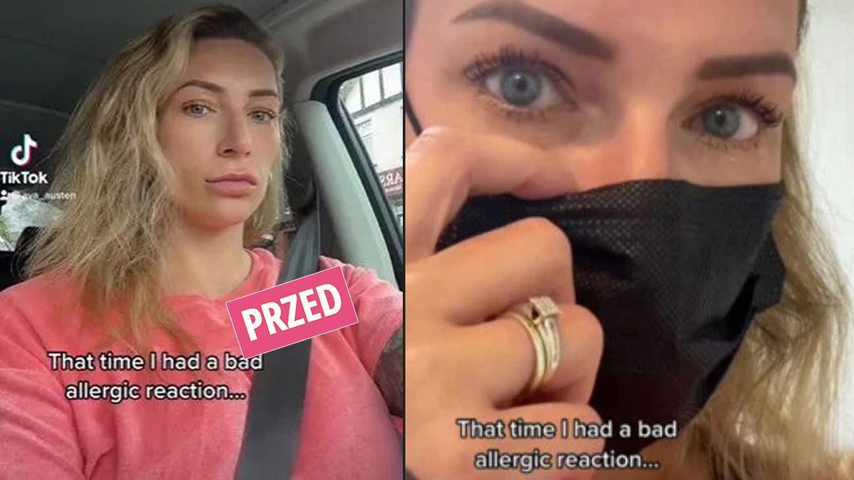 Dostała alergii na wypełniacz ust