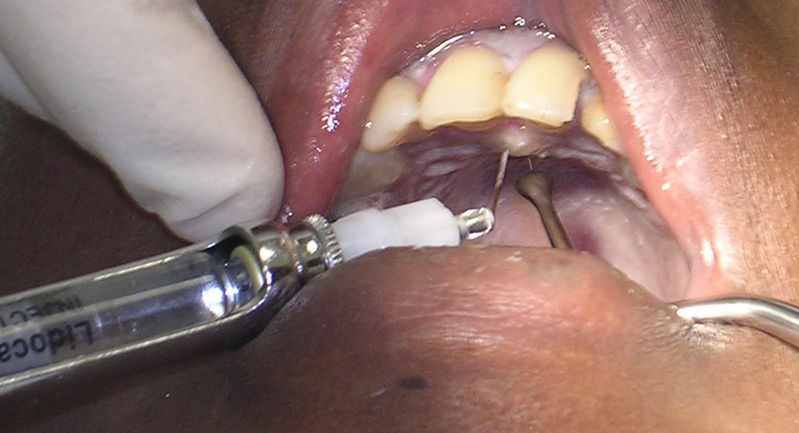 Zastrzyk znieczulający w czasie wizyty u stomatologa 