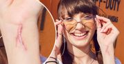 Viki Gabor miała groźny wypadek. Duża blizna zaniepokoiła fanów