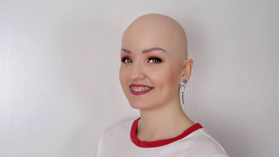 Ola Romańska, fotomodelka cierpiąca na łysienie plackowate 