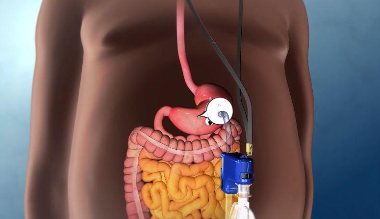 Urządzenie wysysające treść żołądka. Dzięki niemu odchudzanie stanie się prostsze niż kiedykolwiek