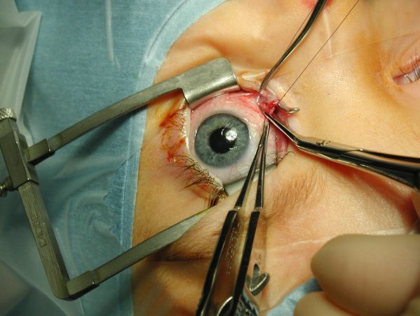 Oko w trakcie operacji zeza  