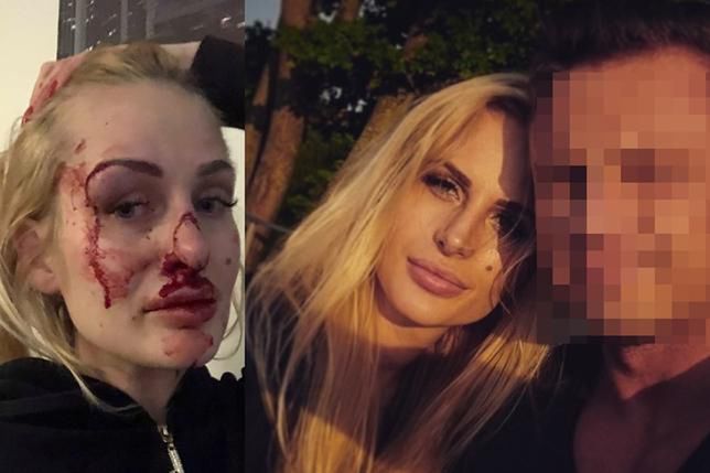 26-letnia Katarzyna Dziedzic postanowiła pokazać w mediach społecznościowych, jak pobił ją były partner.