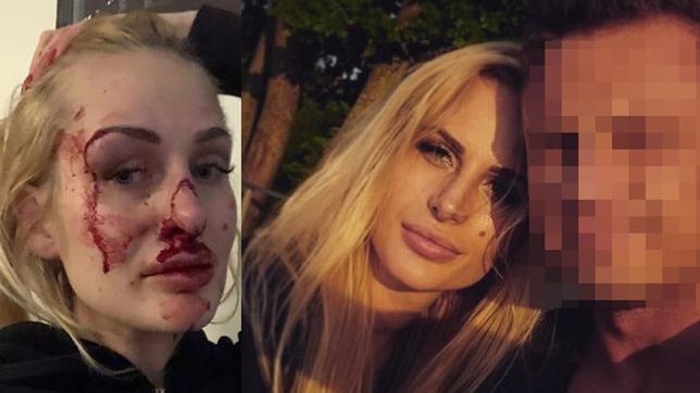 26-letnia Katarzyna Dziedzic postanowiła pokazać w mediach społecznościowych, jak pobił ją były partner.